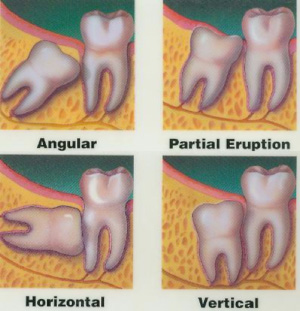 Elliot-Dental-Extractions-Image
