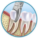 Elliot-Dental-Extractions