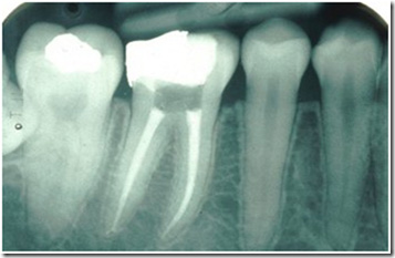 Elliott-Dental-Root-Canal